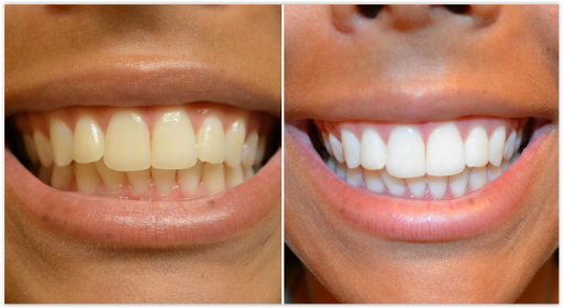 Smileplus™